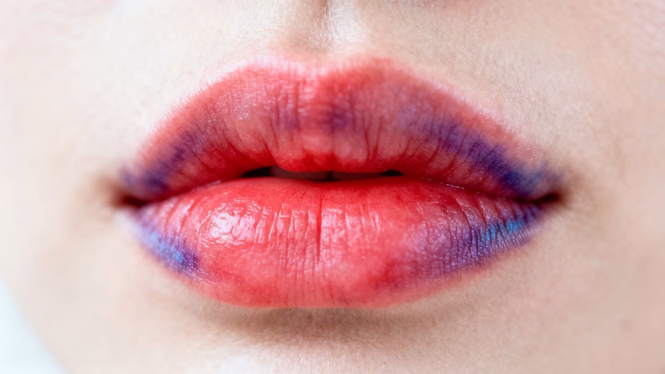 Lips showing swelling and redness after filler treatment.