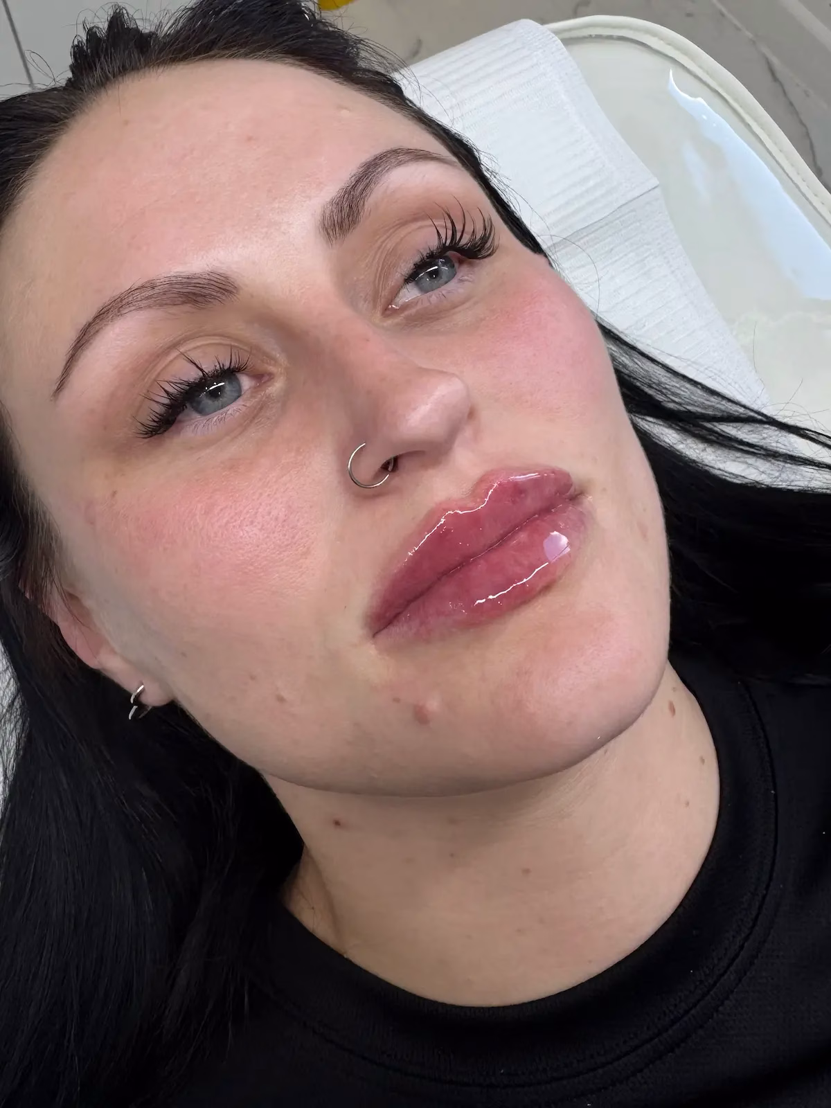 Lip filler treatment at House of Glam HQ, Southsea