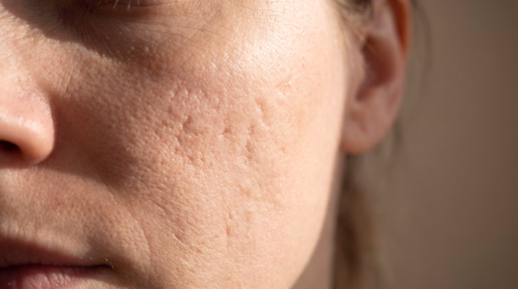 Shallow indented acne scarring across a bare cheek, shown in raking side light