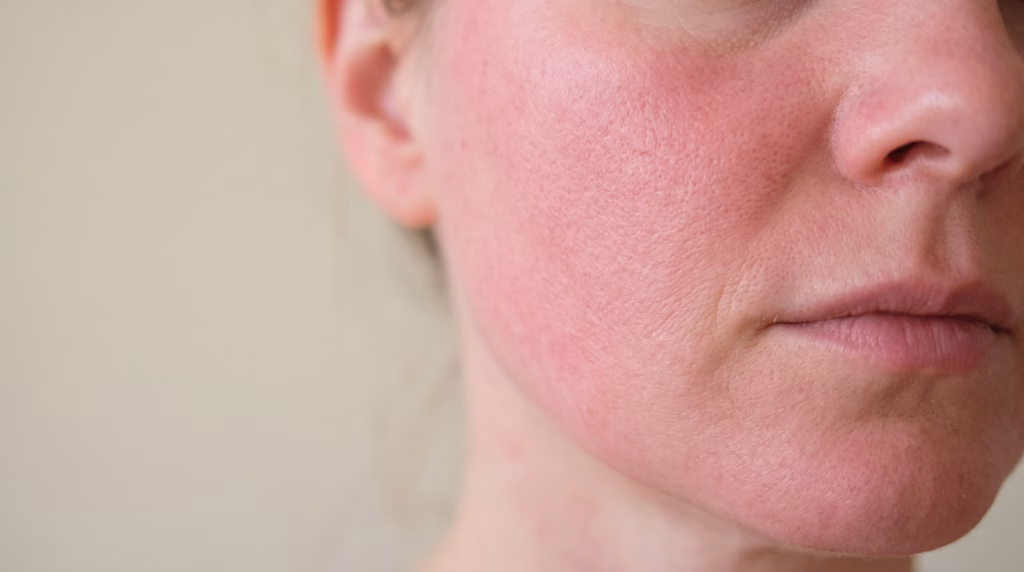 A cheek and jaw evenly flushed pink about a day after microneedling, no makeup and nothing applied
