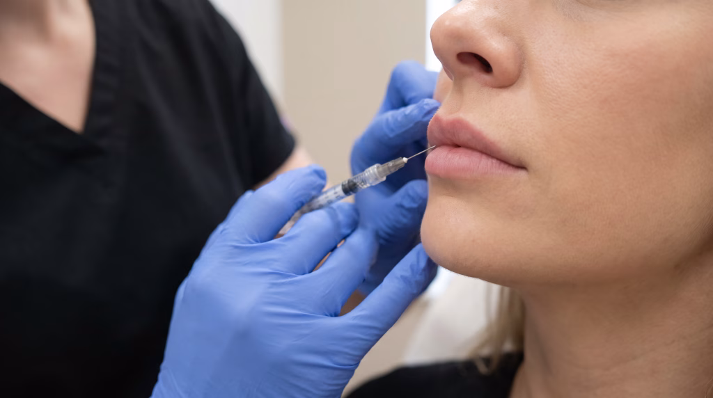 A fine needle run flat along the upper lip border, the placement used for a classic lip filler