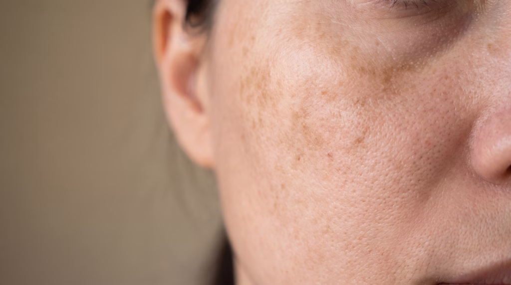 Close-up of a cheek with patchy uneven pigmentation and dullness on bare unmade-up skin