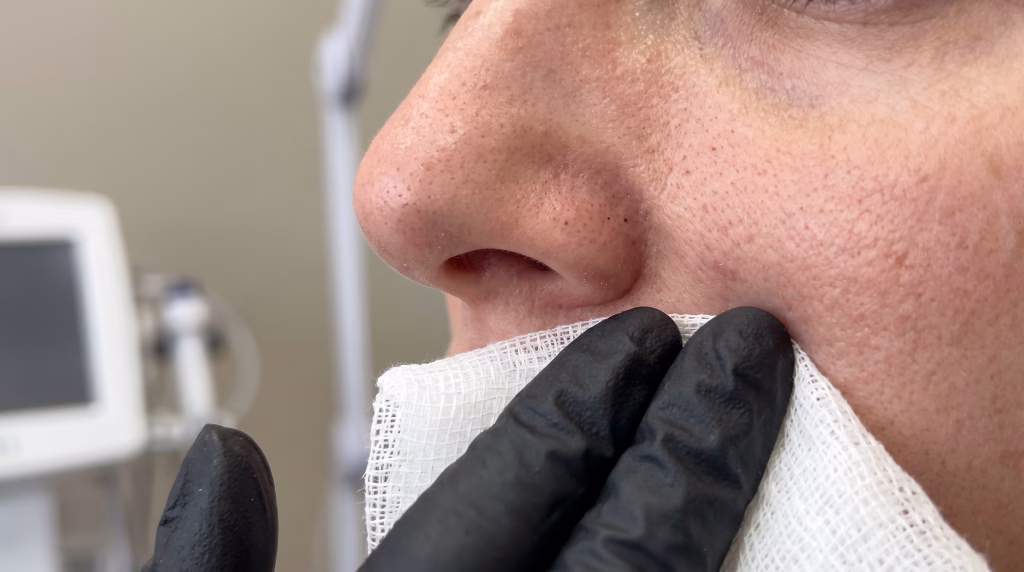 Gloved fingertips wrapped in gauze pressing either side of the nostril crease during a blackhead extraction facial
